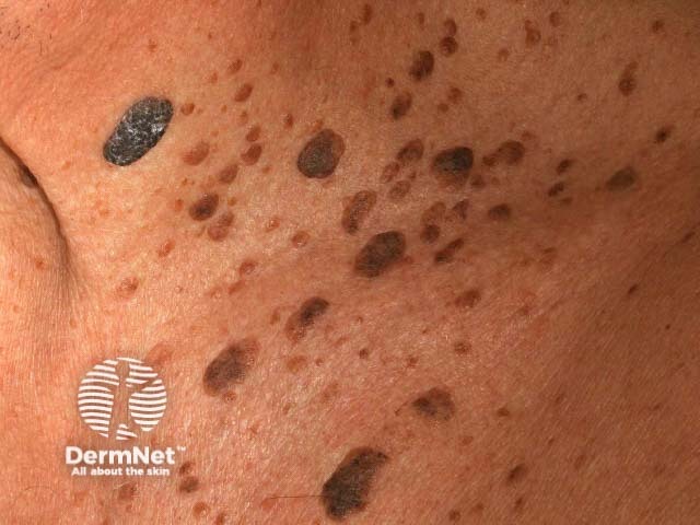 Seborrhoeic keratoses