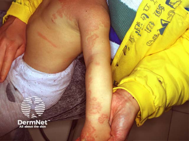 Klippel-Trénaunay syndrome