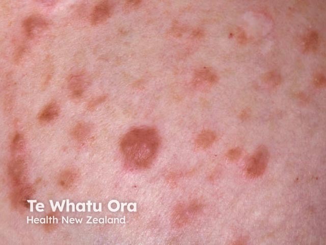 Cutaneous leiomyomatosis