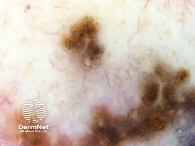 Lentigo maligna melanoma, Breslow 0.8 mm