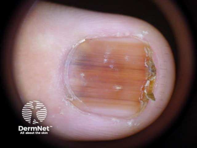 Lentigo simplex of the nail