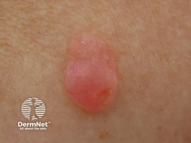 Atypical fibroxanthoma