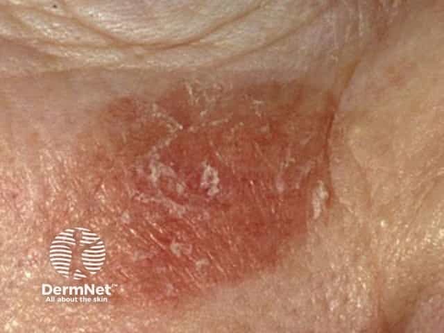 Actinic Keratoses affecting the face