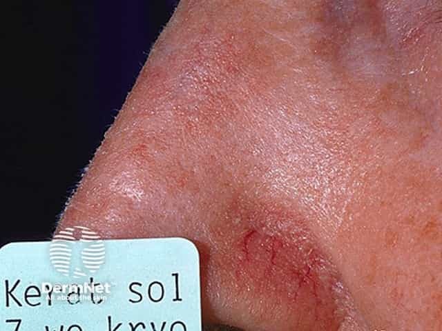 Actinic Keratoses affecting the face