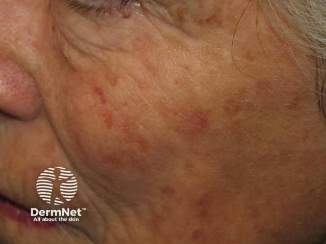 Actinic Keratoses affecting the face