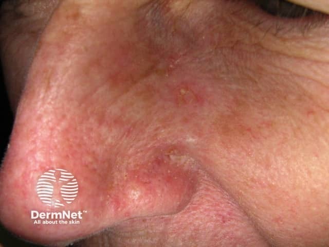 Actinic Keratoses affecting the face