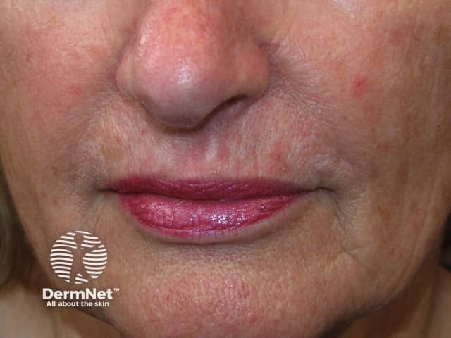 Actinic Keratoses affecting the face