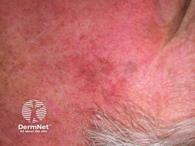 Actinic Keratoses affecting the face