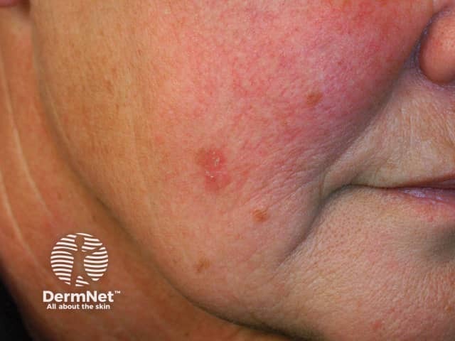 Actinic Keratoses affecting the face