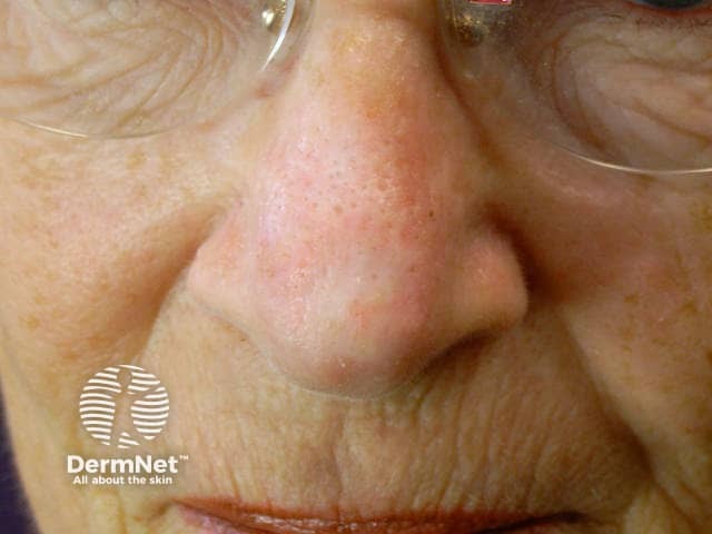 Actinic Keratoses affecting the face