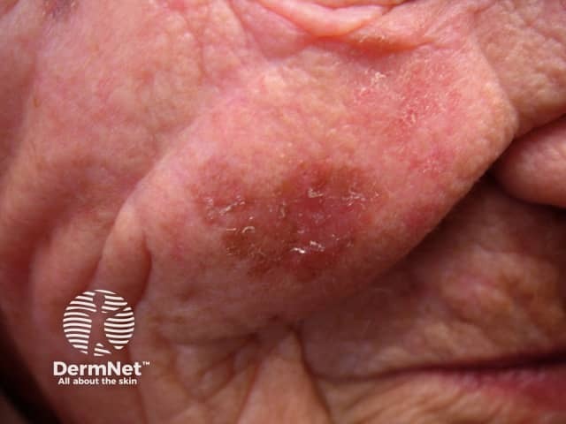 Actinic Keratoses affecting the face