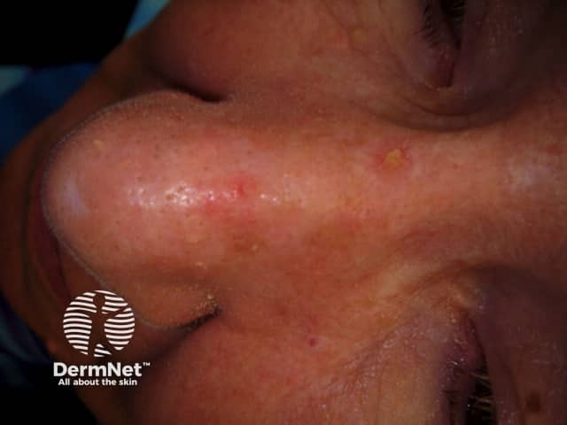 Actinic Keratoses affecting the face