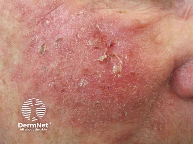 Actinic Keratoses affecting the face