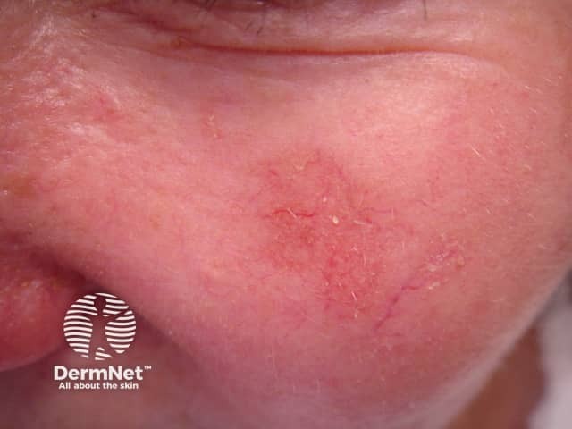 Actinic Keratoses affecting the face