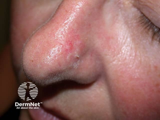 Actinic Keratoses affecting the face