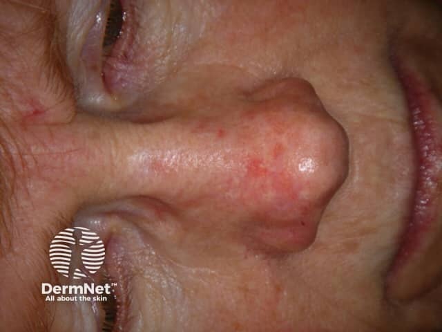 Actinic Keratoses affecting the face