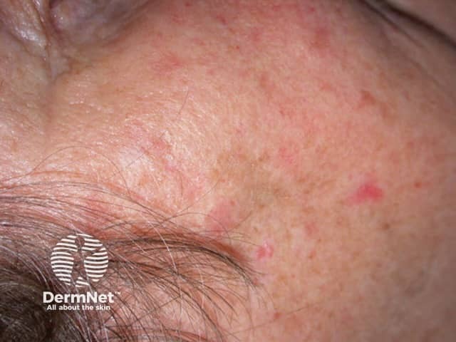 Actinic Keratoses affecting the face