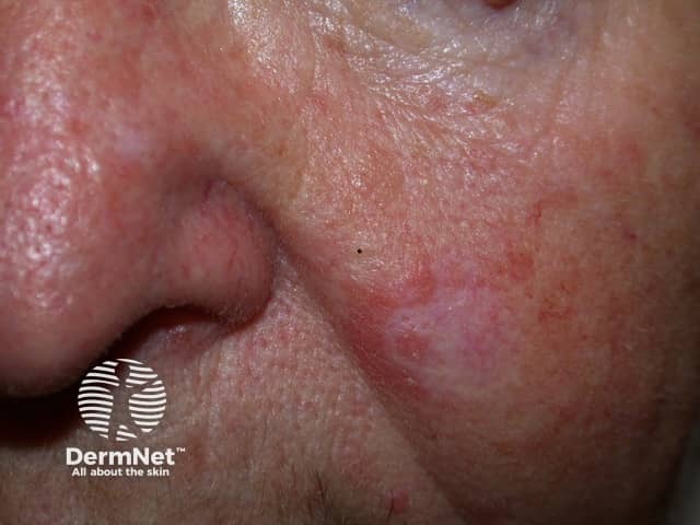 Actinic Keratoses affecting the face