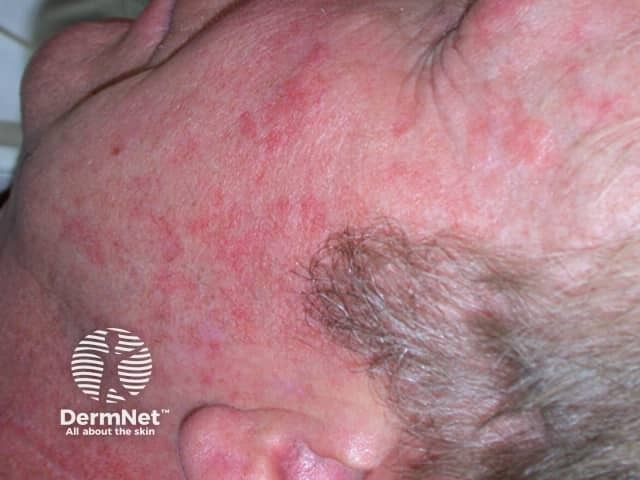 Actinic Keratoses affecting the face