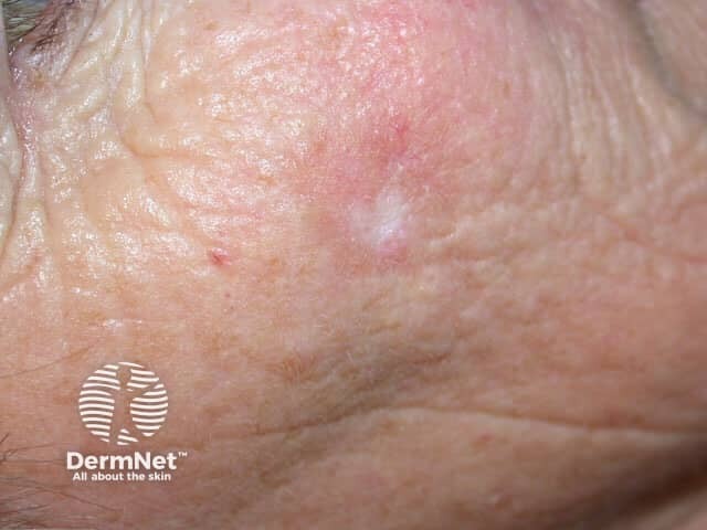 Actinic Keratoses affecting the face