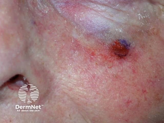 Actinic Keratoses affecting the face