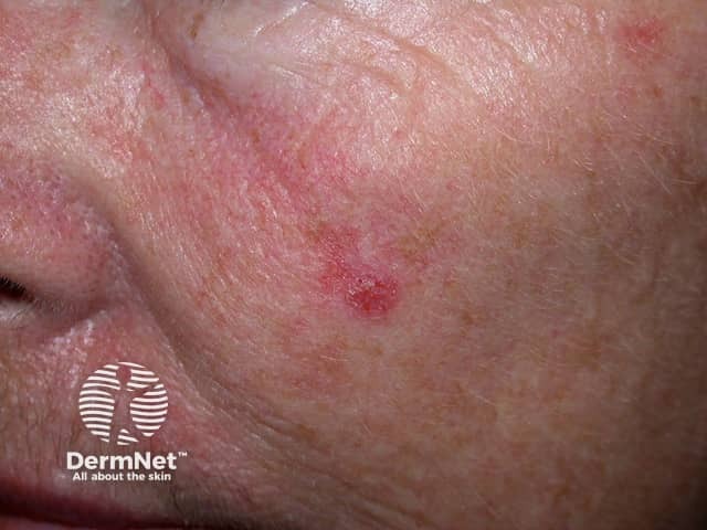 Actinic Keratoses affecting the face