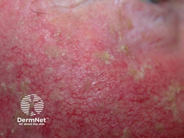 Actinic Keratoses affecting the face