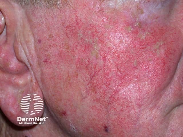 Actinic Keratoses affecting the face