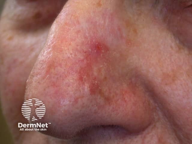 Actinic Keratoses affecting the face