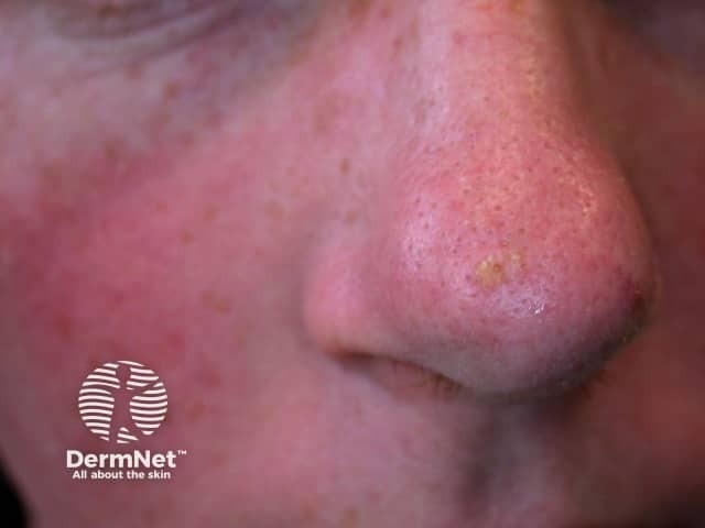 Actinic Keratoses affecting the face