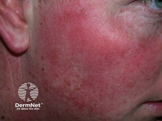 Actinic Keratoses affecting the face