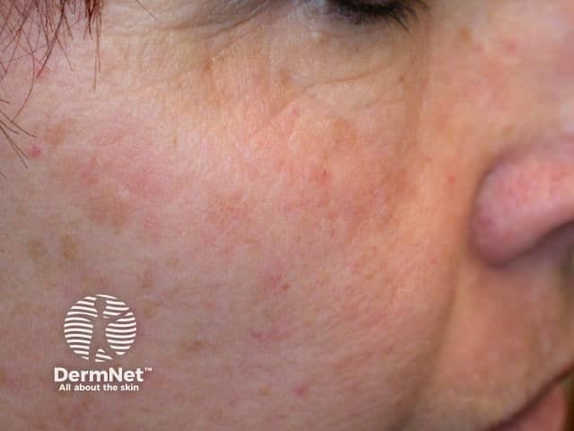 Actinic Keratoses affecting the face