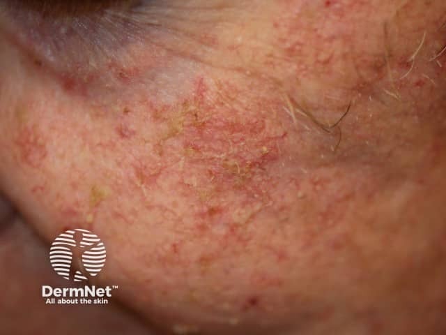 Actinic Keratoses affecting the face