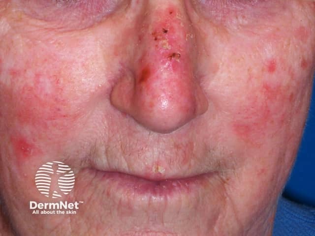 Actinic Keratoses affecting the face