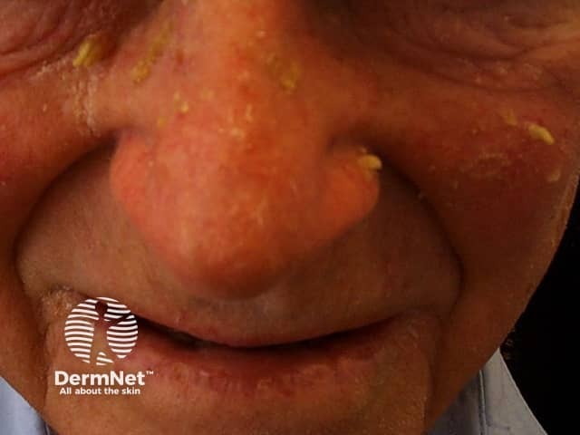 Actinic Keratoses affecting the face