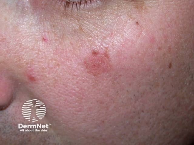 Actinic Keratoses affecting the face