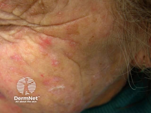 Actinic Keratoses affecting the face