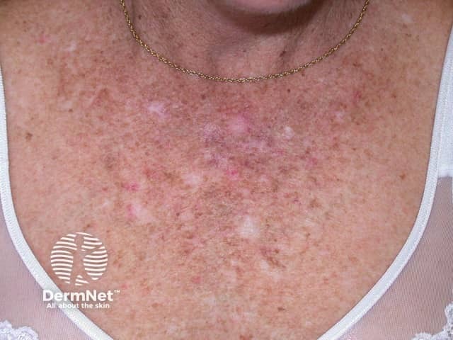 Actinic Keratoses affecting the face