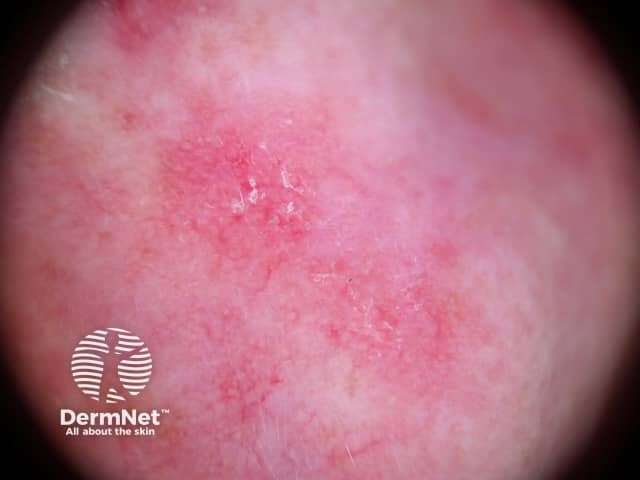 Actinic Keratoses affecting the face