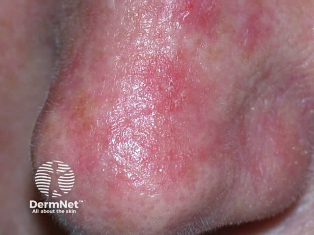 Actinic Keratoses affecting the face