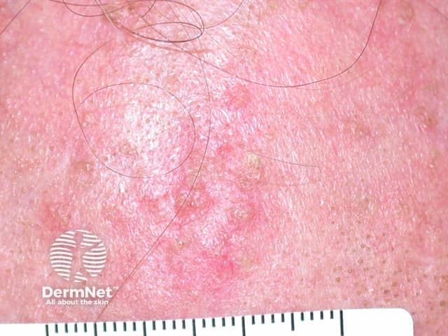 Actinic Keratoses affecting the face