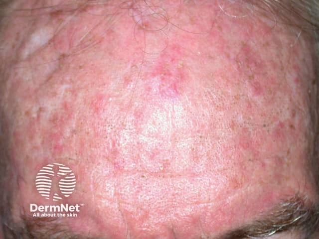 Actinic Keratoses affecting the face