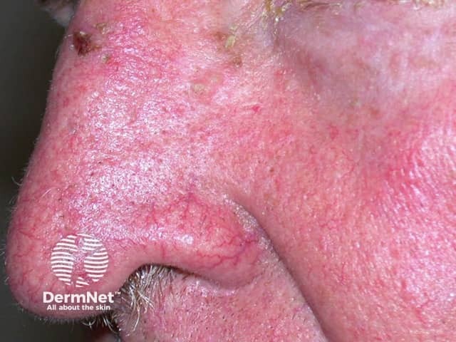 Actinic Keratoses affecting the face