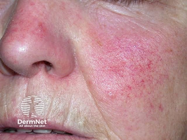 Actinic Keratoses affecting the face