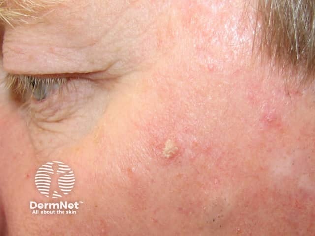 Actinic Keratoses affecting the face