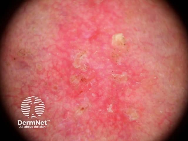 Dermoscopy of actinic keratosis on the face