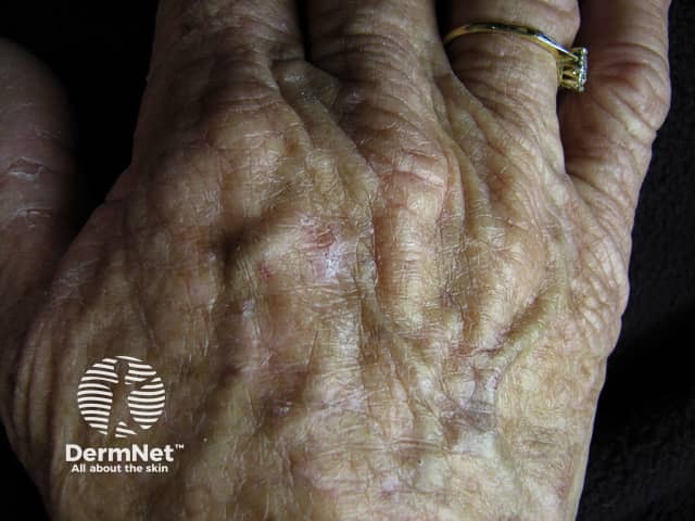 Actinic keratoses affecting the hands