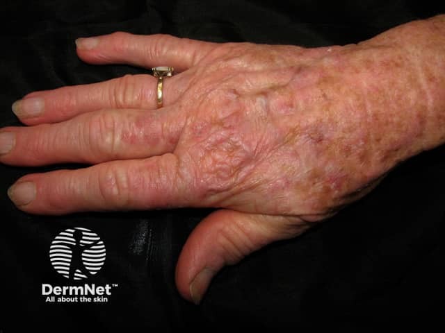 Actinic keratoses affecting the hands