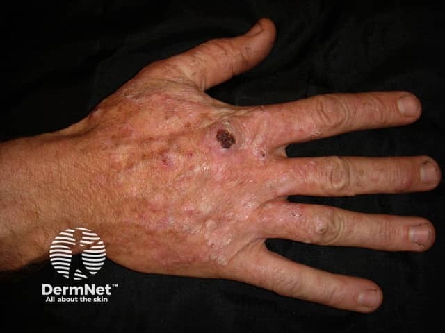 Actinic keratoses affecting the hands