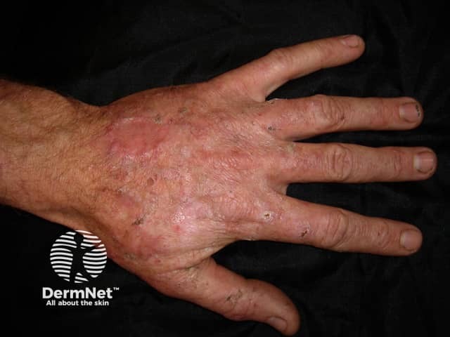 Actinic keratoses affecting the hands